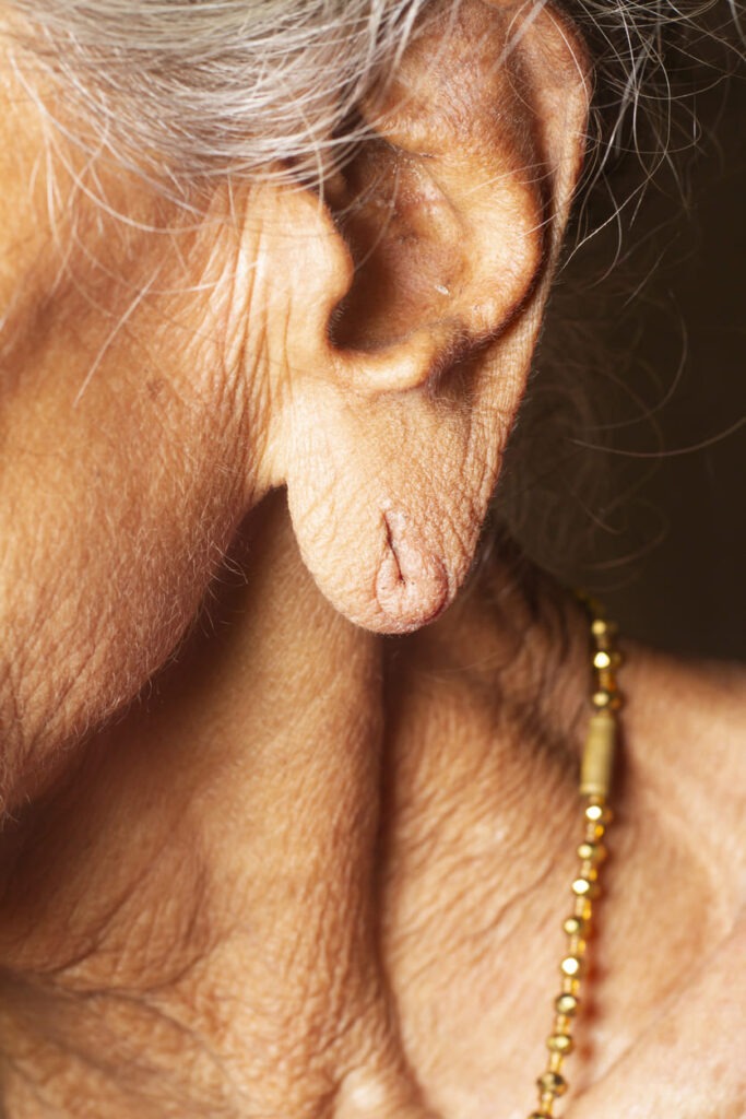How to deal with crepey long earlobes
